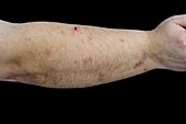 Dermatitis artefacta on the arm