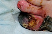 Gangrene of the toe
