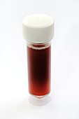 Urine sample with blood