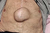 Incisional hernia of the chest