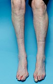 Poliomyelitis of the leg
