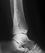 Fibrosis on lower leg,X-ray