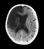 Cerebral stroke,CT scan