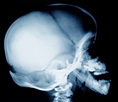 Bone growth disorder of skull,X-ray