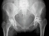 Rheumatoid arthritis of the hip,X-ray