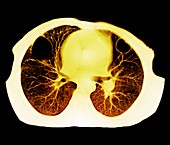 Lung abscess,CT scan