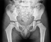 Growth disorder of thigh bone,X-ray