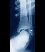Sprained ankle,X-ray