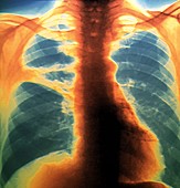 Collapse (atelectasis) of lung,X-ray
