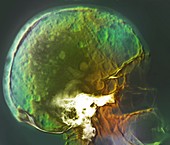Skull in bone marrow cancer,X-ray