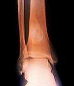 Fibroma on the leg bone,X-ray