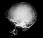 Skull with Sturge-Weber syndrome,X-ray
