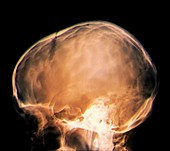 Hypertension inside the skull,X-ray