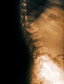Spine in Morquio syndrome,X-ray