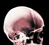Skull in Apert-Crouzon syndrome,X-ray