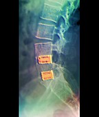 Fusion of spinal bones,X-ray
