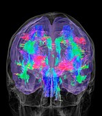 Brain white matter,3D MRI scan