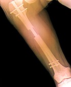 Extension of the thigh bone,X-ray