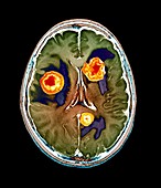 Secondary brain cancer,MRI scan