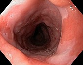 Patch of abnormal oesophagus cells