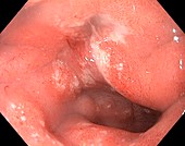 Duodenal ulcer