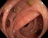 Diverticular disease in sigmoid colon