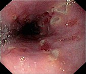 Crohn's disease in the oesophagus