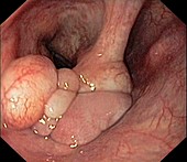 Fibrolipoma in the larynx