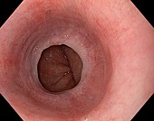 Oesophageal web from reflux