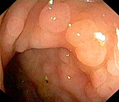 Benign polyps in the rectum