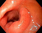 Scar from a duodenal ulcer
