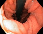 Hiatus hernia of the stomach