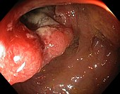 Cancer of the colon and rectum