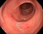 Inflamed colon from viral gastroenteritis