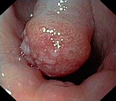 Large polyp in the stomach