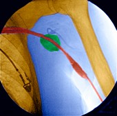 Balloon angioplasty,Coloured X-ray