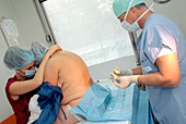 Epidural anaesthesia before childbirth