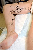 Varicose vein removal