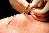 Varicose vein removal