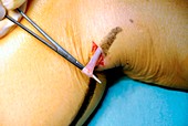 Varicose vein removal