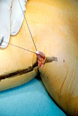 Varicose vein removal