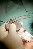Heart pacemaker surgery
