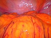 Healthy bladder,laparoscopic view