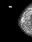Breast cancer X-ray