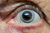 Arcus senilis disorder of the eye