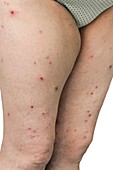 Infected flea bites on the legs