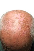 Hypopigmentation on the scalp