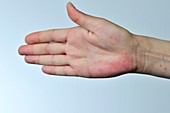 Red rash (erythema) on the palm