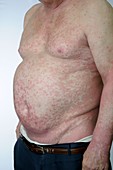 Psoriasis from immunosuppression therapy