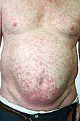 Psoriasis from immunosuppression therapy